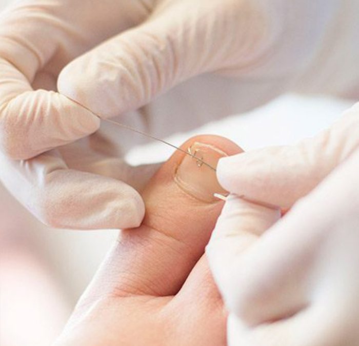 Sposoby leczenia wrastających paznokci