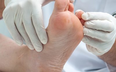 Modzele w praktyce podologicznej: Kompleksowa diagnostyka, etiopatogeneza i zaawansowane protokoły kliniczne