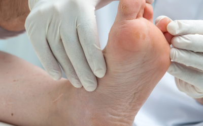 Pękające pięty u seniora – specyfika pracy ze skórą starczą